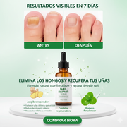 Spray antihongos para uñas natural