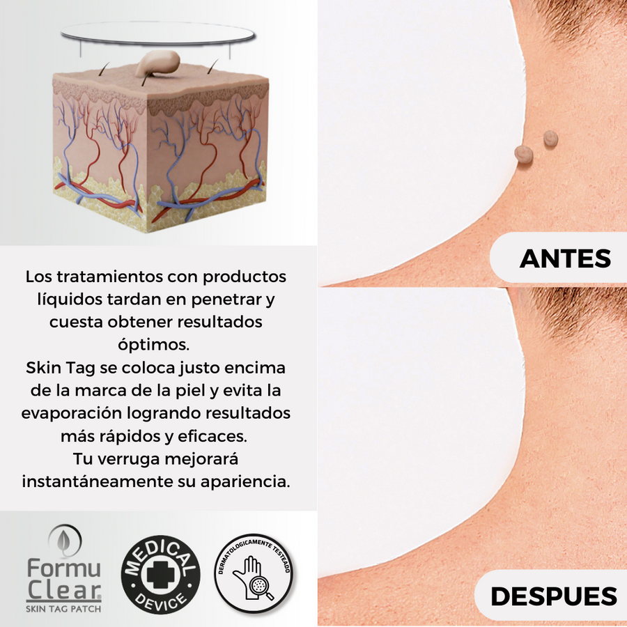 Parches para verrugas sin dolor