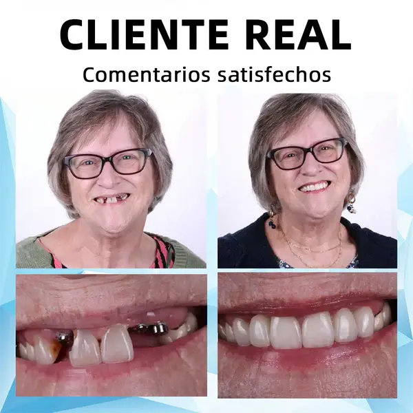 Prótesis dental de silicona estética